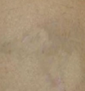 Tattoo Removal Treatment- Sagittarius After 5 Treatments . Sharplight